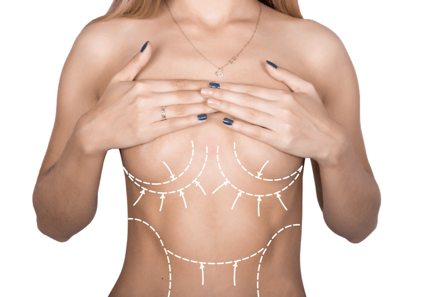 Breast Augmentation Surgery